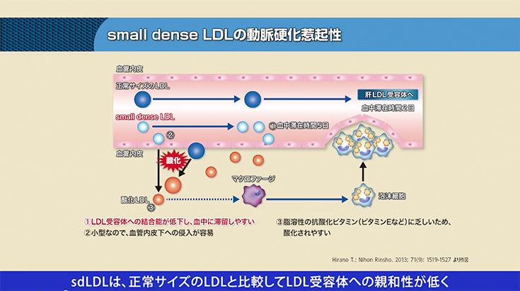 高中性脂肪（TG）血症とsmall dense LDL